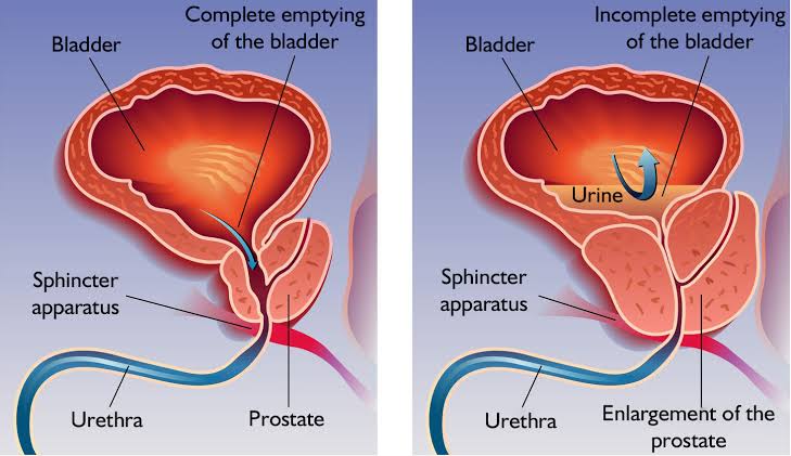 Bladder and prostate anatomy showing obstruction
