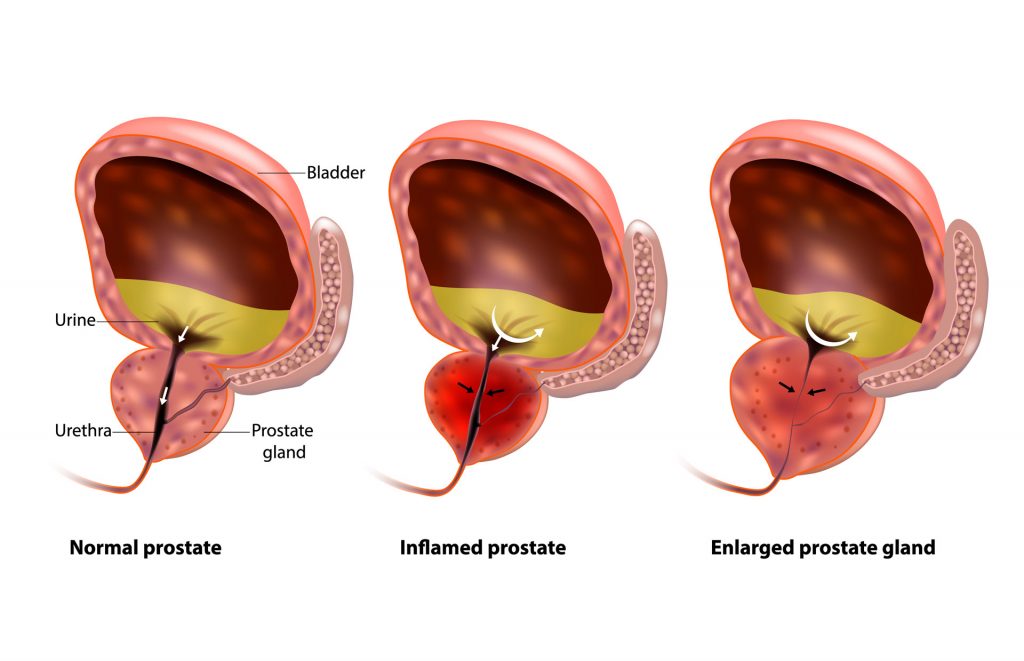 Nocturia causes infographic - bladder, urine production, lifestyle