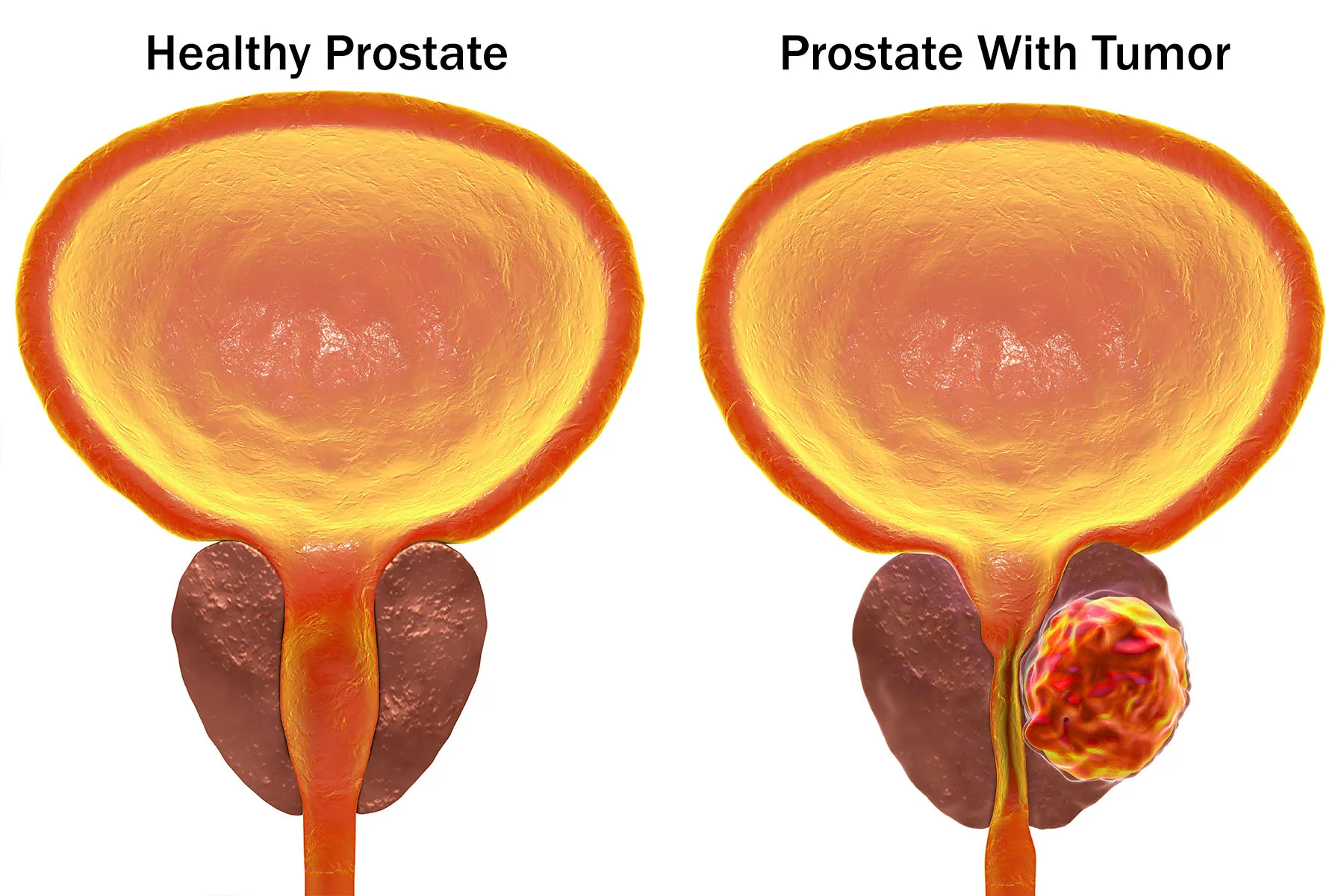 Bladder and prostate anatomy showing obstruction